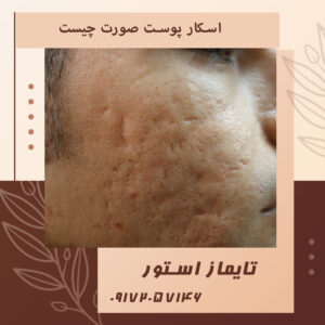 اسکار پوست صورت چیست