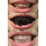 خمیر دندان زغالی دکتر راشل